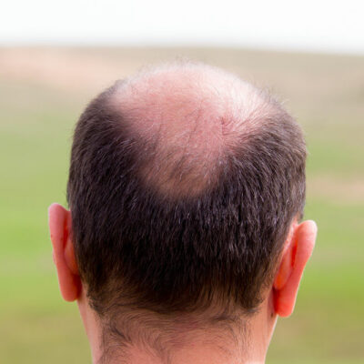 Natural Ways to Manage Male Pattern Baldness