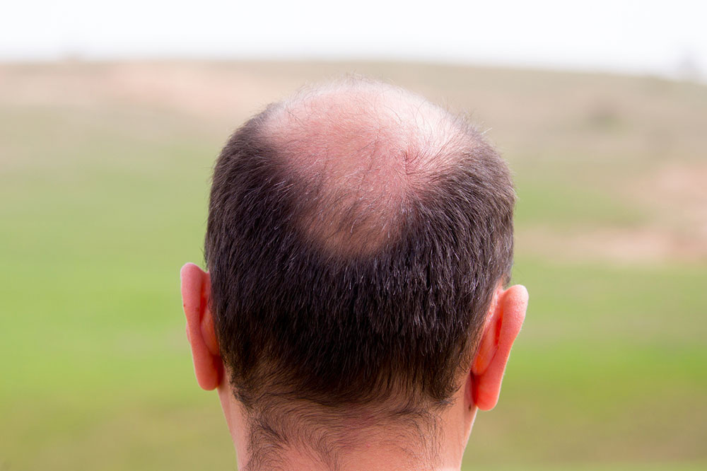 Natural Ways to Manage Male Pattern Baldness